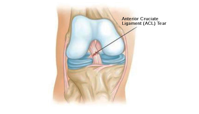Arthroscopic ACL Surgery