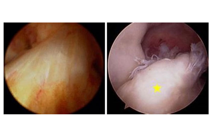 ACL Surgical Treatment