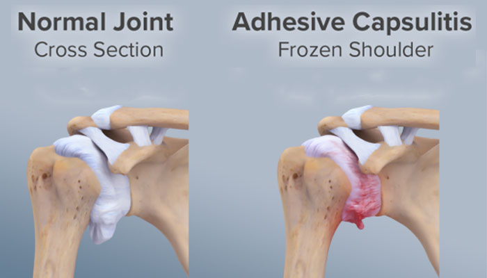 frozen shoulder