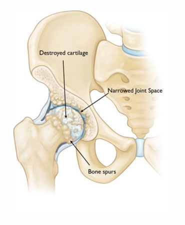 Hip Replacement