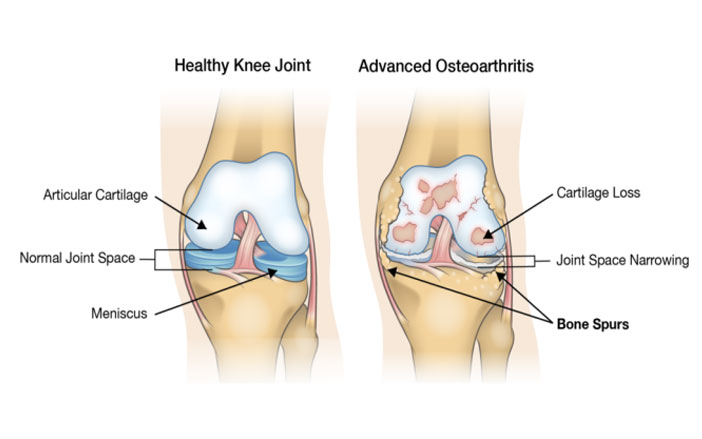 knee osteoarthritis jain hospital gurgaon ortho