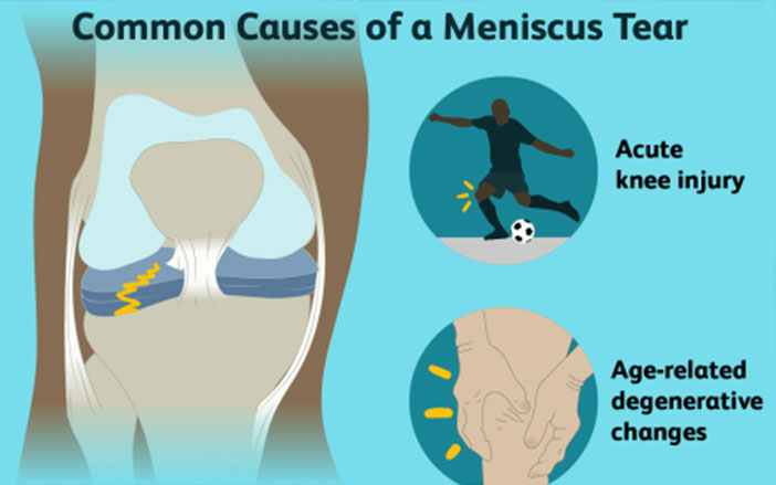 Meniscus Tears