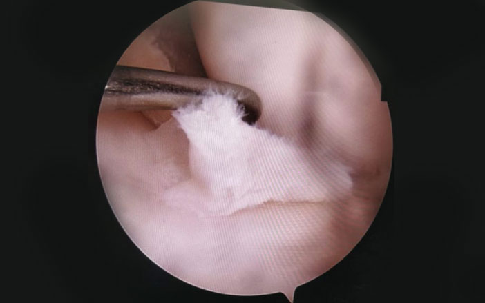 Meniscus Tears
