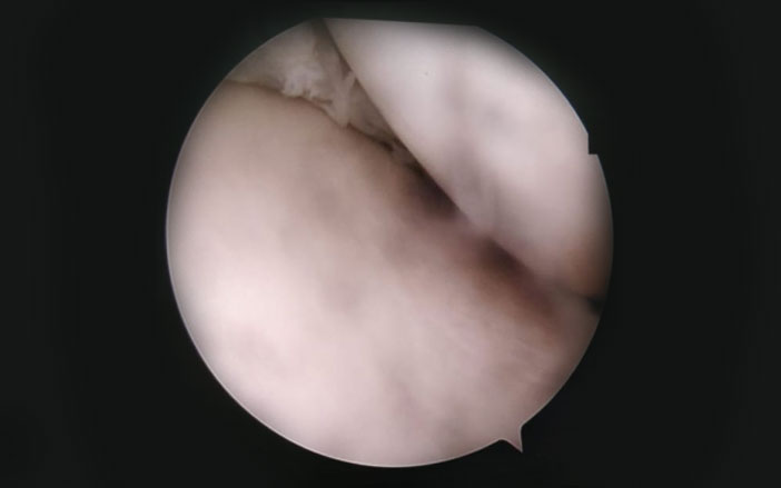 Meniscus Tears