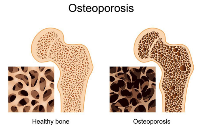 Osteoporosis