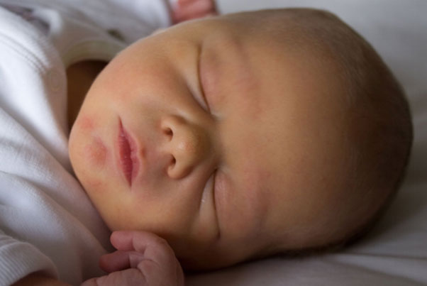 Newborn jaundice - Phototherapy