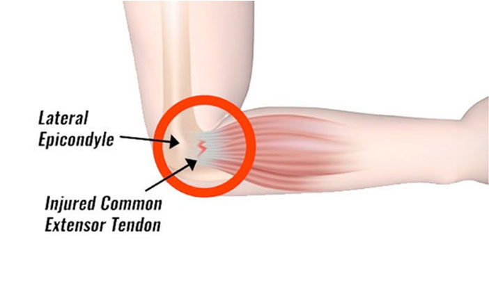 Tennis Elbow Jain hospital gurgaon ortho treatments